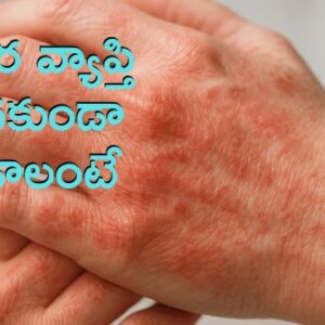 Read more about the article తామరను తగ్గించుకోవడానికి ఇలాంటి సులభమైన మార్గాలు అనుసరించవచ్చు