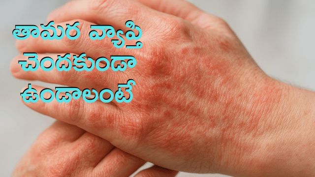 Read more about the article తామరను తగ్గించుకోవడానికి ఇలాంటి సులభమైన మార్గాలు అనుసరించవచ్చు