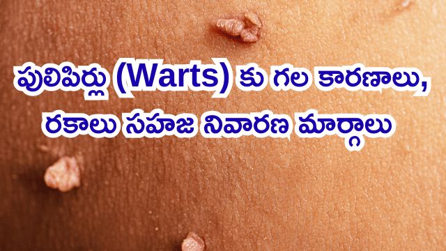 Read more about the article పులిపిర్లు (Warts) వేధిస్తున్నాయా? కారణాలు, రకాలు మరియు సహజ నివారణ మార్గాలపై పూర్తి గైడ్!